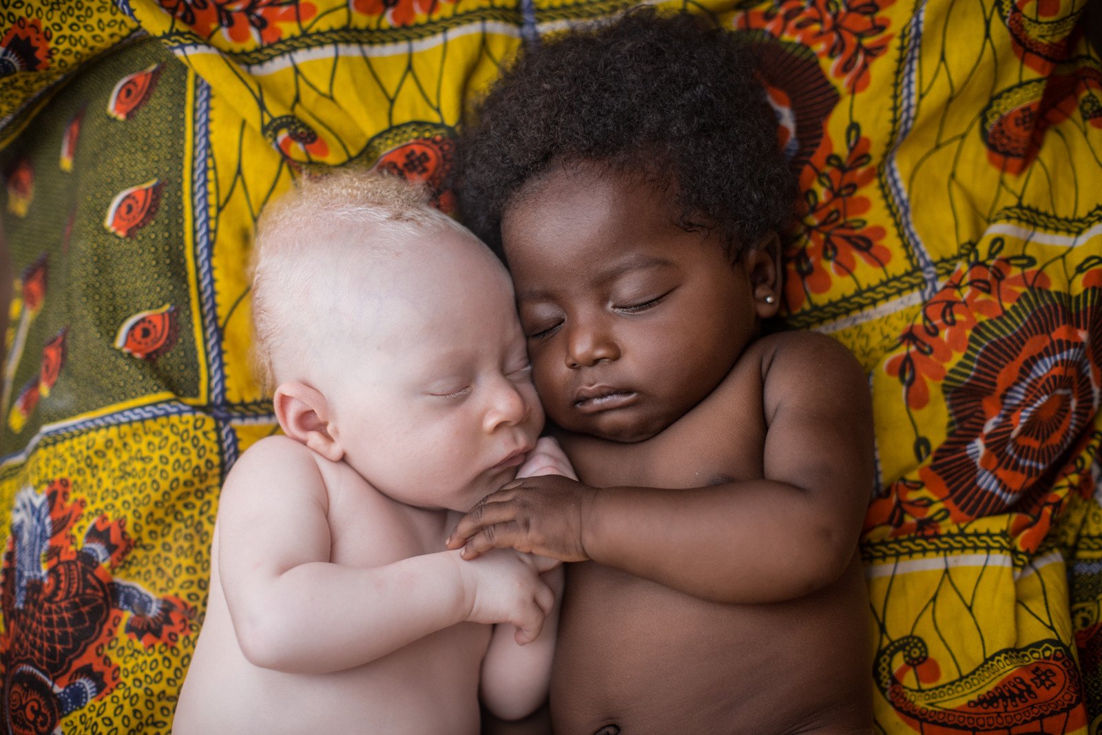 3 weeks-old newborn with albinism happily sleeping with his cousin in Kinshasa, Congo photo Patricia Willocq Human Diversity