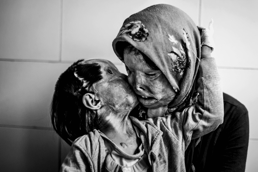 A mother and her 3 year-old daughter, who were attacked with acid by their husband-father Human Diversity