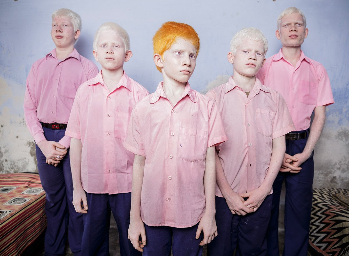 Blind albino boys in their boarding room at a mission school for the blind in West Bengal, India, 2013 Human Diversity