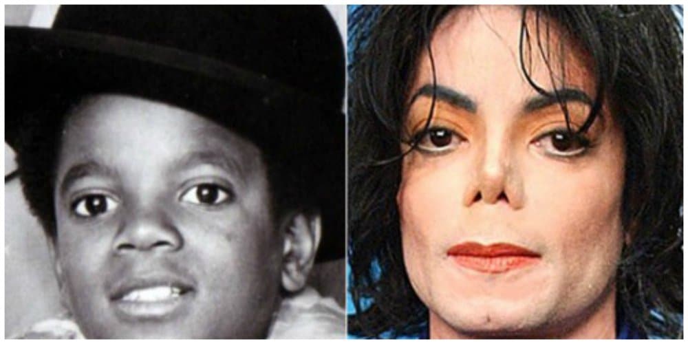 michael jackson surgery