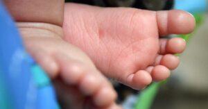 Understanding Metatarsus Adductus in Babies Causes, Symptoms, and Severity Levels